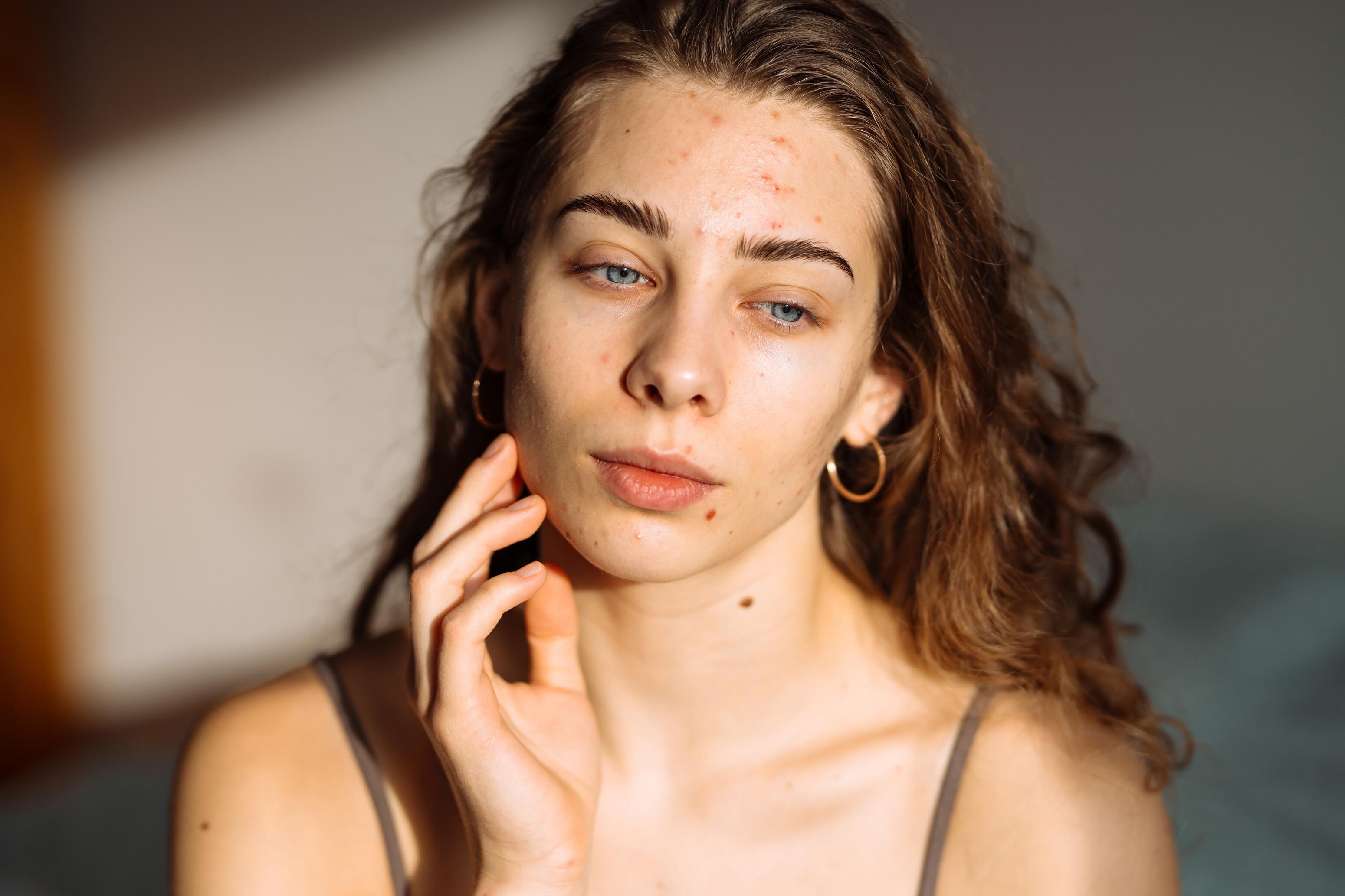 Acne en blootstelling aan de zon: gevolgen en aanbevolen maatregelen